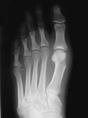 AAOS Orthopedic MCQs (Set 3): Foot & Ankle Trauma & Pathology | ABOS Board Prep