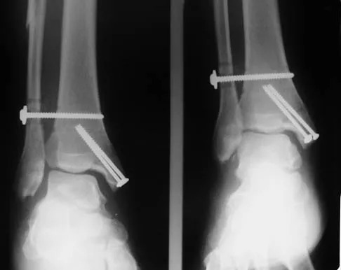 Foot & Ankle Board Review 2006: High-Yield MCQs (Set 2) - Figure 1