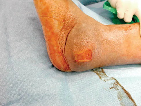 Foot & Ankle Board Review 2006: High-Yield MCQs (Set 2) - Figure 16