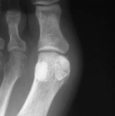 Foot & Ankle Board Review 2006: High-Yield MCQs (Set 2) - Figure 32