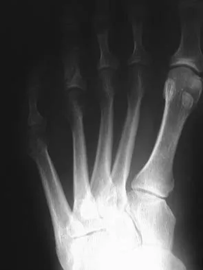 Foot & Ankle Board Review 2006: High-Yield MCQs (Set 2) - Figure 5