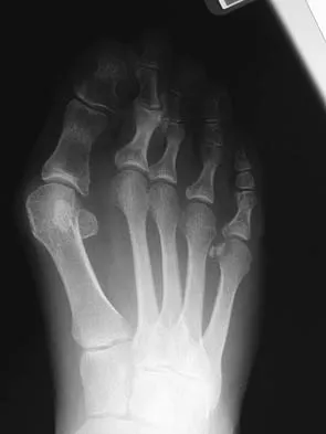 Foot & Ankle Board Review 2006: High-Yield MCQs (Set 2) - Figure 8