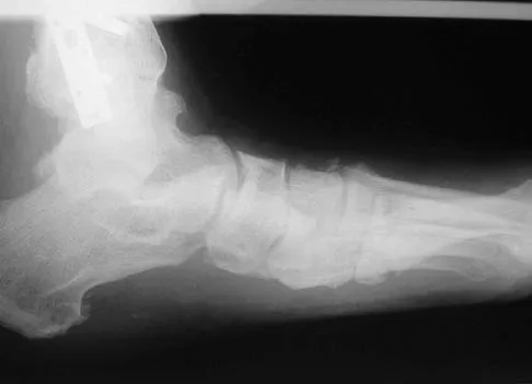 Foot & Ankle 2006 Practice Questions: Set 3 (Solved) - Figure 4