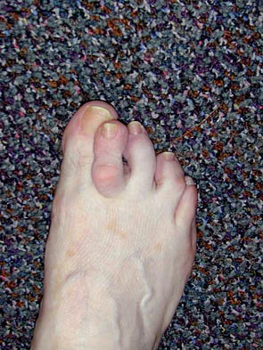 Click to enlarge Foot & Ankle Board Review 2006: High-Yield MCQs (Set 4) - Figure 1