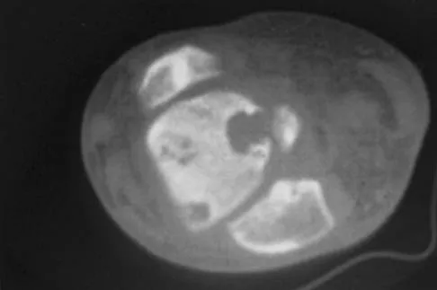 Foot & Ankle Board Review 2006: High-Yield MCQs (Set 4) - Figure 11