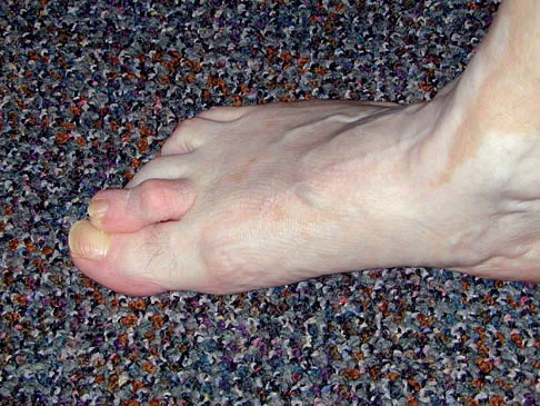 Click to enlarge Foot & Ankle Board Review 2006: High-Yield MCQs (Set 4) - Figure 2