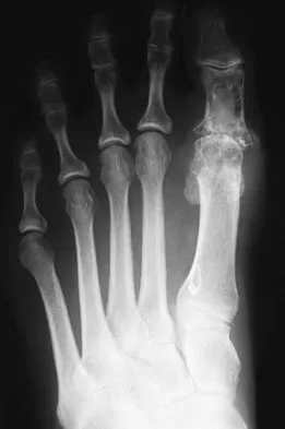AAOS Orthopedic MCQs (Set 1): Foot & Ankle Trauma & Deformities | Board Review