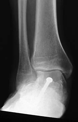 Foot & Ankle 2009 Practice Questions: Set 1 (Solved) - Figure 8