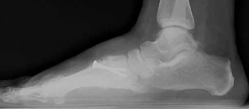 Foot & Ankle Board Review 2009: High-Yield MCQs (Set 2) - Figure 11