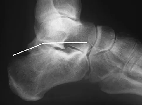 Foot & Ankle Board Review 2009: High-Yield MCQs (Set 2) - Figure 17