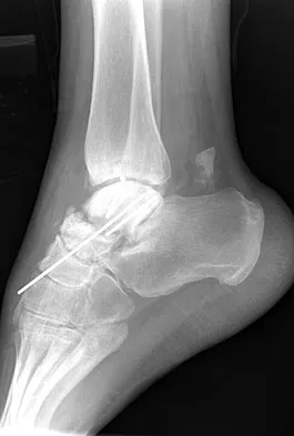 Foot & Ankle Board Review 2009: High-Yield MCQs (Set 2) - Figure 28