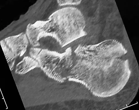 Foot & Ankle Board Review 2009: High-Yield MCQs (Set 2) - Figure 35