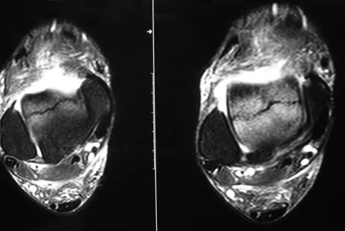 Foot & Ankle Board Review 2009: High-Yield MCQs (Set 2) - Figure 4