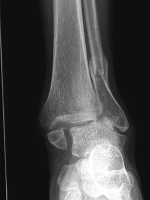 AAOS & ABOS Orthopedic MCQs: Foot & Ankle Set 3 | Board Prep Questions