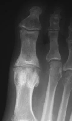 Foot & Ankle Board Review 2009: High-Yield MCQs (Set 4) - Figure 10