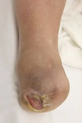 Foot & Ankle Board Review 2009: High-Yield MCQs (Set 4) - Figure 16