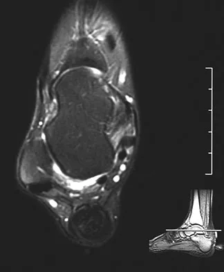 Foot & Ankle Board Review 2009: High-Yield MCQs (Set 4) - Figure 21