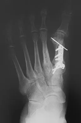 Foot & Ankle Board Review 2009: High-Yield MCQs (Set 4) - Figure 8