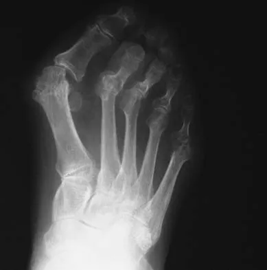 Foot & Ankle 2026 MCQs: Board Review Questions & Answers (Part 1) - Figure 123