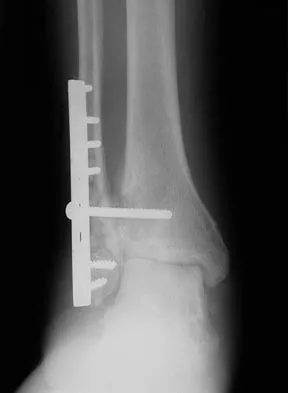 Foot & Ankle 2026 MCQs: Board Review Questions & Answers (Part 1) - Figure 125