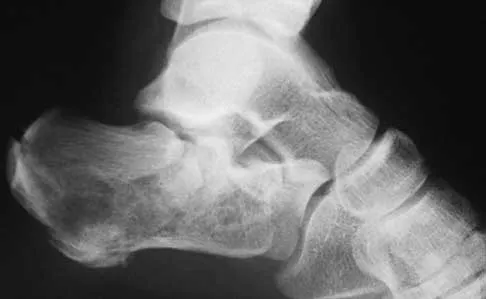 Foot & Ankle 2026 MCQs: Board Review Questions & Answers (Part 1) - Figure 17