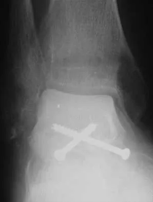 Foot & Ankle 2026 MCQs: Board Review Questions & Answers (Part 1) - Figure 6