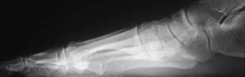 Foot & Ankle 2026 MCQs: Board Review Questions & Answers (Part 1) - Figure 93