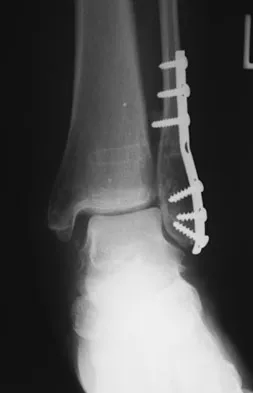 Foot & Ankle 2026 MCQs: Board Review Questions & Answers (Part 2) - Figure 141