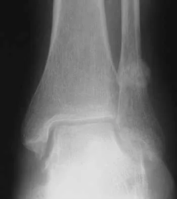 Foot & Ankle 2026 MCQs: Board Review Questions & Answers (Part 2) - Figure 17