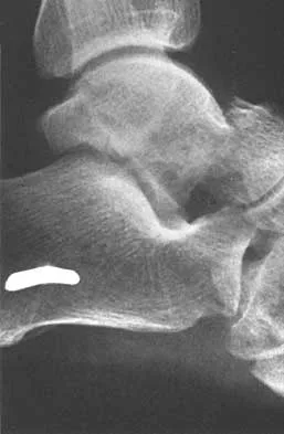 Foot & Ankle 2026 MCQs: Board Review Questions & Answers (Part 2) - Figure 37