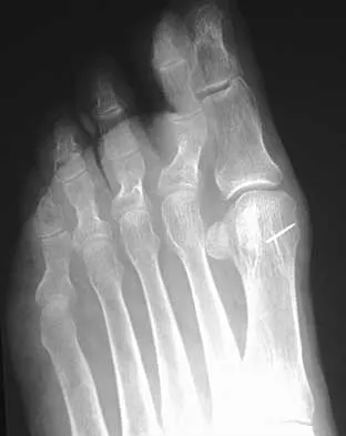 Foot & Ankle 2026 MCQs: Board Review Questions & Answers (Part 2) - Figure 61