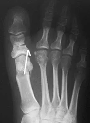 Foot & Ankle 2026 MCQs: Board Review Questions & Answers (Part 2) - Figure 77