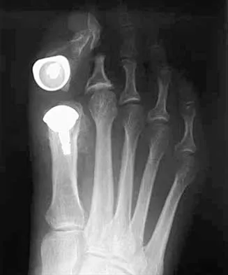 Orthopedic Foot & Ankle MCQs (Set 4): Ankle Fractures, Deformities & Tendon Injuries | AAOS & ABOS Board Review