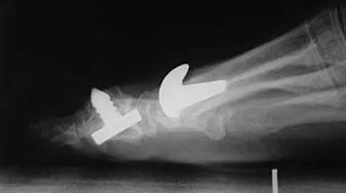 Foot & Ankle 2026 MCQs: Board Review Questions & Answers (Part 4) - Figure 3