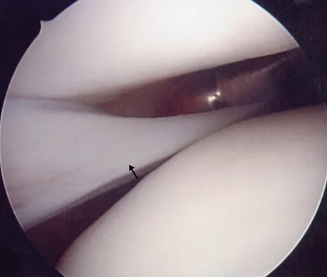 AAOS & ABOS Orthopedics MCQs (Set 1): Lower Extremity Trauma & Arthroplasty Complications | 2026 Board Prep