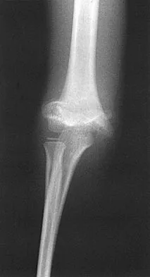 AAOS, ABOS & SMLE Orthopedic MCQs (Set 10): Adult Hip Arthroplasty, Spine Trauma & Knee Ligament Injuries | Board Review 2026