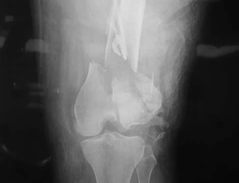 General Orthopedics Board Review 2026: High-Yield MCQs (Set 10) - Figure 71