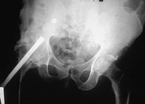 General Orthopedics 2026 Practice Questions: Set 11 (Solved) - Figure 2