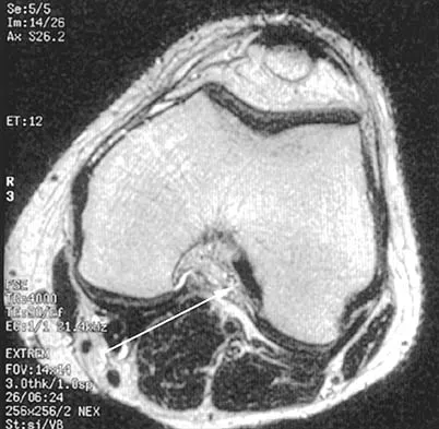 AAOS & ABOS Orthopedic MCQs (Set 12): Fracture Principles, Degenerative Joints & Knee Ligaments | 2026 Board Review