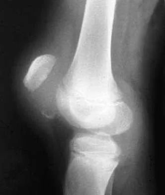 General Orthopedics Board Review 2026: High-Yield MCQs (Set 12) - Figure 46