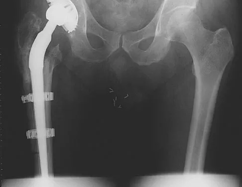 General Orthopedics Board Review 2026: High-Yield MCQs (Set 12) - Figure 74