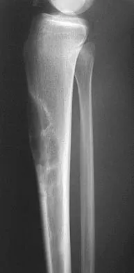 General Orthopedics Board Review 2026: High-Yield MCQs (Set 14) - Figure 100