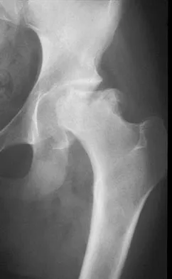 AAOS Orthopedic MCQs (Set 1): Spine, Arthroplasty & Trauma Principles | 2026 Board Prep