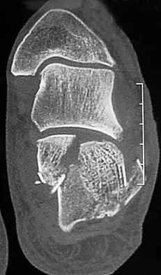 General Orthopedics Board Review 2026: High-Yield MCQs (Set 16) - Figure 49