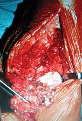 General Orthopedics Board Review 2026: High-Yield MCQs (Set 16) - Figure 58