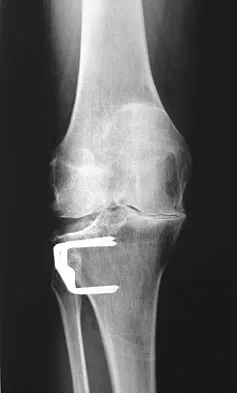 AAOS & ABOS Orthopedic MCQs (Set 18): Fracture Management, Joint Arthroplasty & Sports Medicine