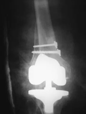 General Orthopedics Board Review 2026: High-Yield MCQs (Set 18) - Figure 64