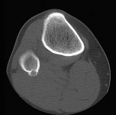 General Orthopedics Board Review 2026: High-Yield MCQs (Set 2) - Figure 132