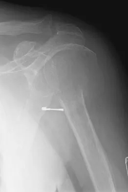 General Orthopedics Board Review 2026: High-Yield MCQs (Set 20) - Figure 51