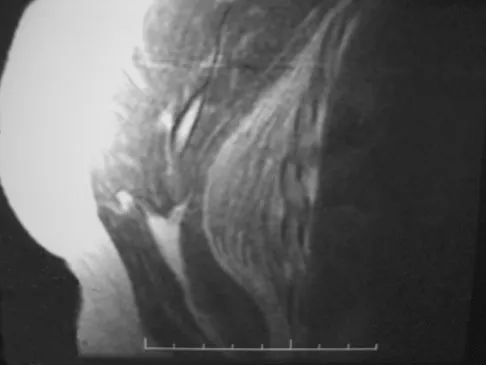 AAOS Orthopedic MCQs (Set 3): Lower Extremity Trauma, Spine & Knee Injuries | 2026 Board Prep